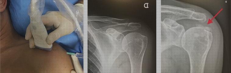Opiniones de los 14 mejores Tendon Supraespinoso Rehabilitacion Vendas