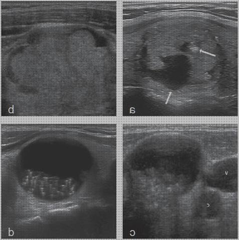 Los mejores 8 Tiroides Nodulos Ecos Mixtos Sin Flujos Doppler Intralesional