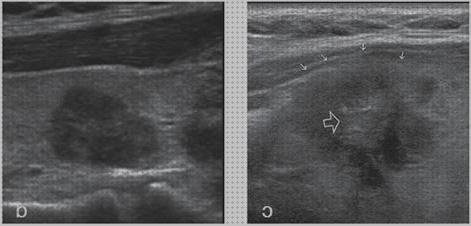 Las mejores tiroides doppler tiroides nodulos eco mixtos sin flujo doppler intralesional