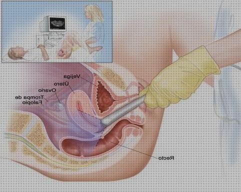 Review de transvaginal