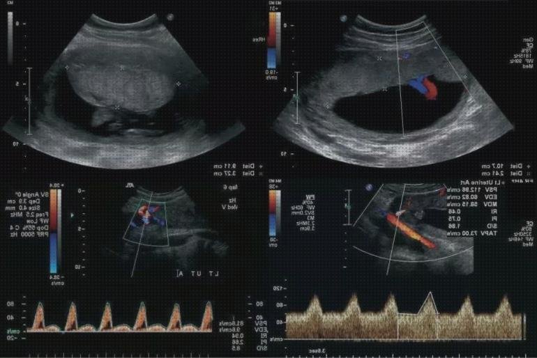 Las mejores doppler uterino