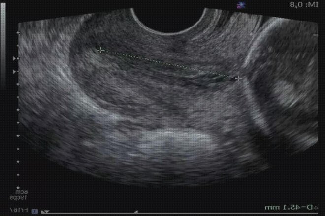 Review de uterino
