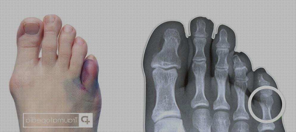 Las mejores marcas de vendas inmovilizar hombro Mas vendas perros pata Mas vendas postoperatorias vendas inmovilizar dedo pue