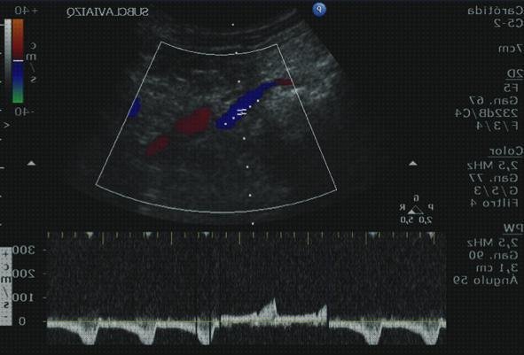 Las mejores marcas de vertebral doppler eco doppler vertebral